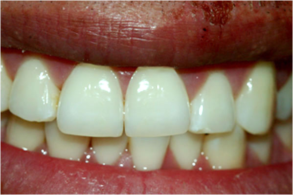 Lava Crowns After 