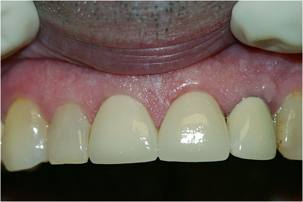 Lava Crowns After