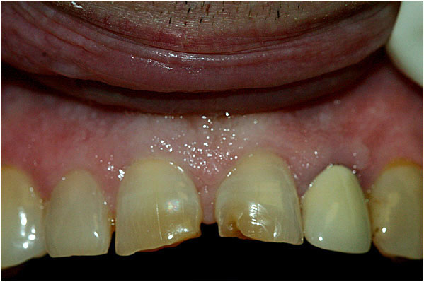 Lava Crowns Before 